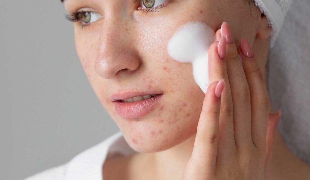 Top Tips for Acne-Free Skin: Achieve Clear, Radiant Skin Today