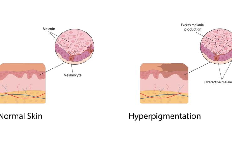 How to Get Rid of Dark Spots with Kojic Acid