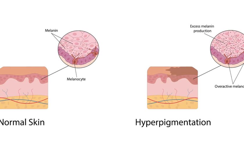 How to Get Rid of Dark Spots with Kojic Acid