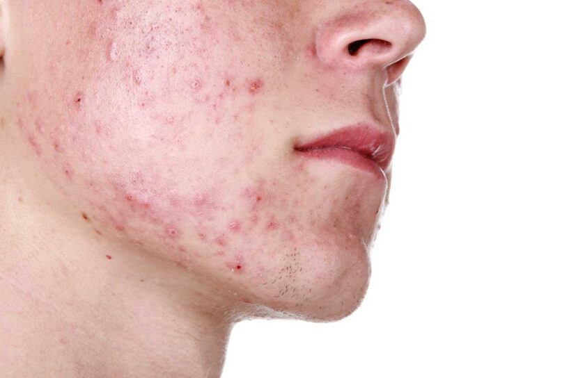 Face Acne: Best Practices for Teenagers