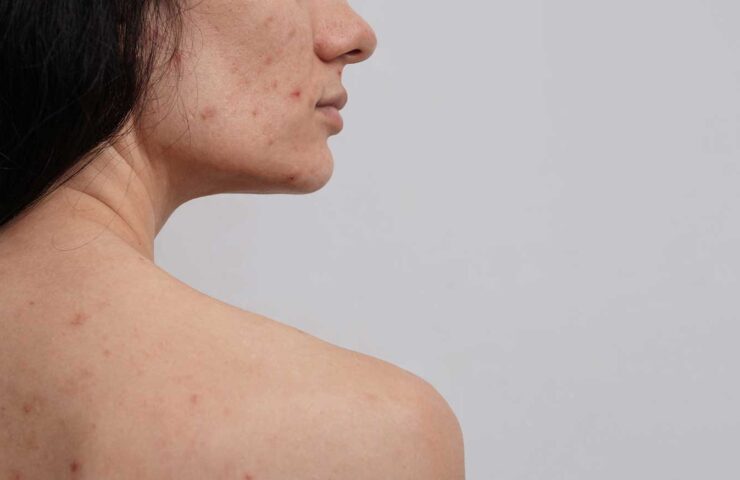 Effective Strategies for Managing Body Acne