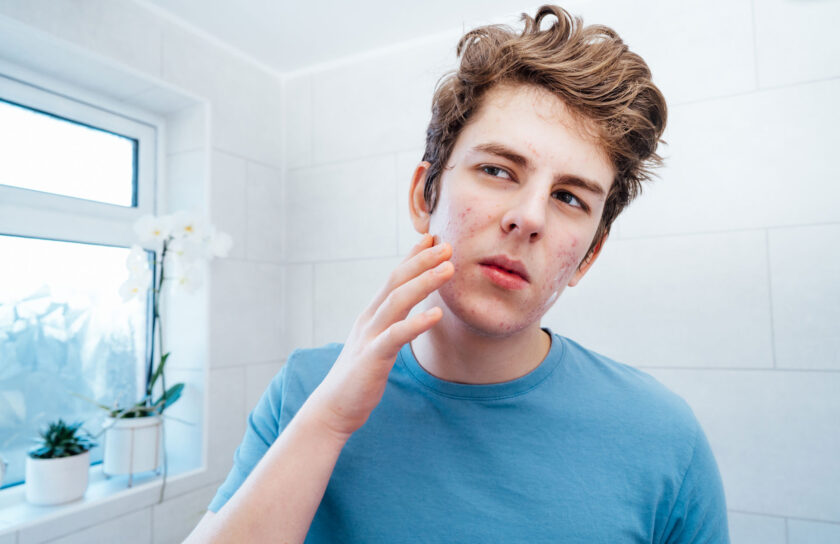 The Remarkable Benefits of Salicylic Acid on Acne- A Professional Perspective