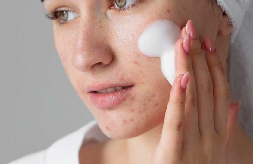 Top Tips for Acne-Free Skin: Achieve Clear, Radiant Skin Today