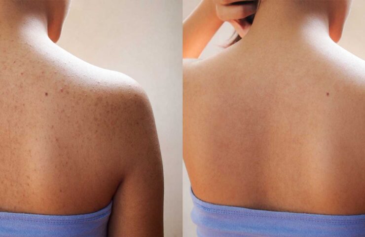 How to Fade Acne Scars on Your Body Effectively