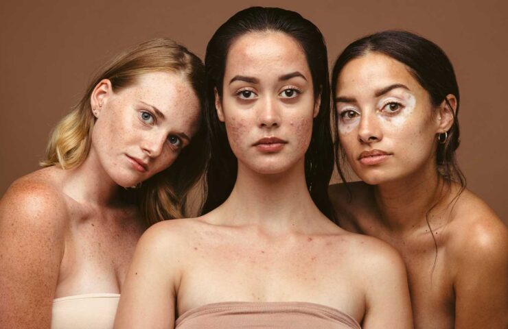 Adult Body Acne: