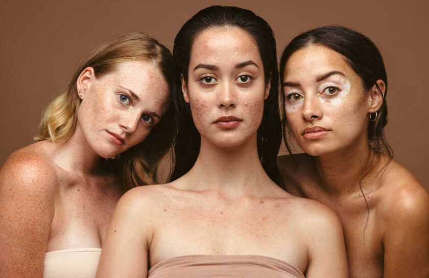 Adult Body Acne: