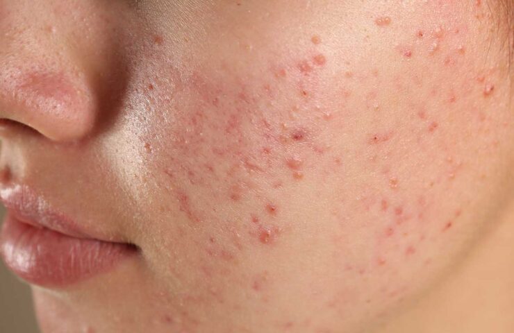 Close-up of teen skin with acne and excess oil, showing the need for a targeted face wash
