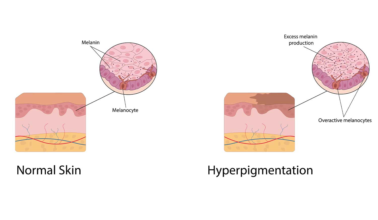 How to Get Rid of Dark Spots with Kojic Acid
