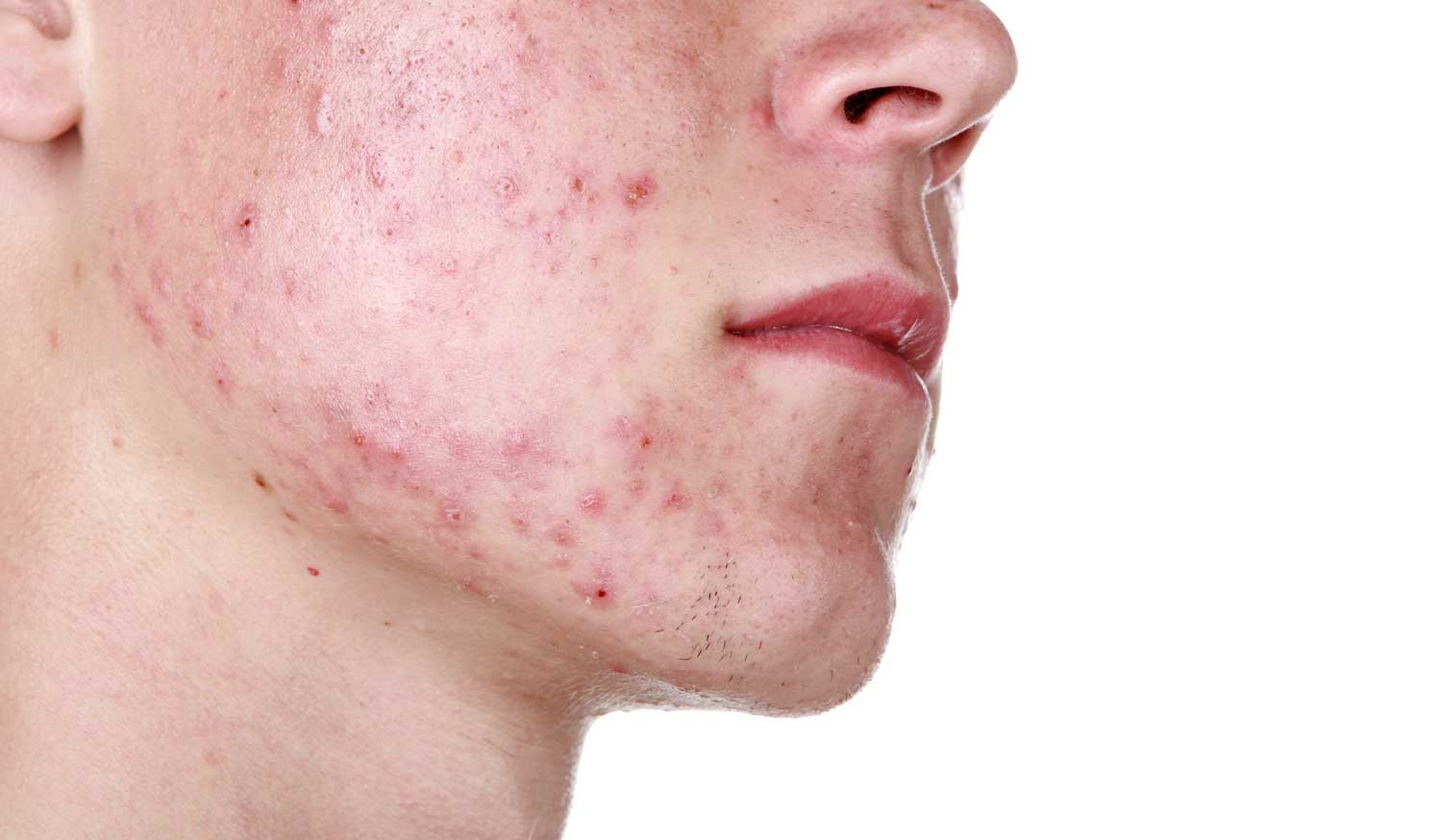 Face Acne: Best Practices for Teenagers