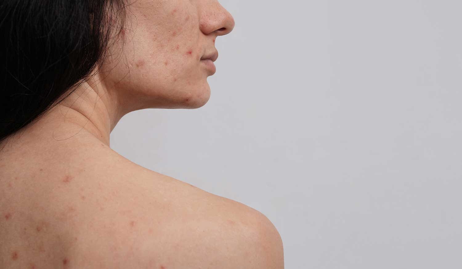 Effective Strategies for Managing Body Acne