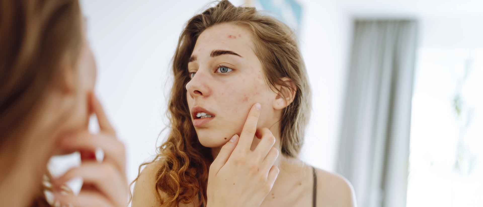 How to Get Rid of Acne