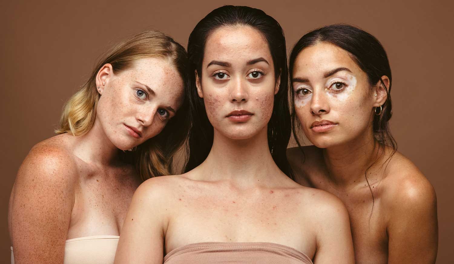 Adult Body Acne:
