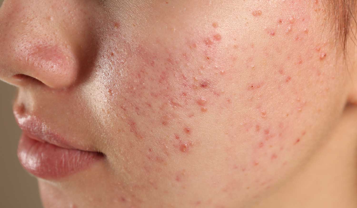 Close-up of teen skin with acne and excess oil, showing the need for a targeted face wash